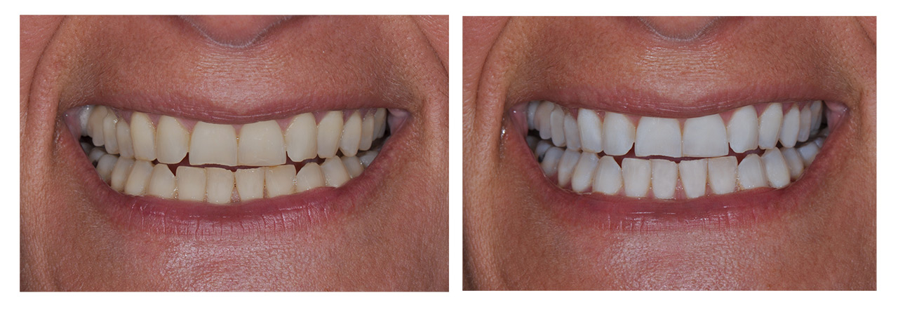Zahnarztpraxis Dr. Nicola Schüren - Bleaching