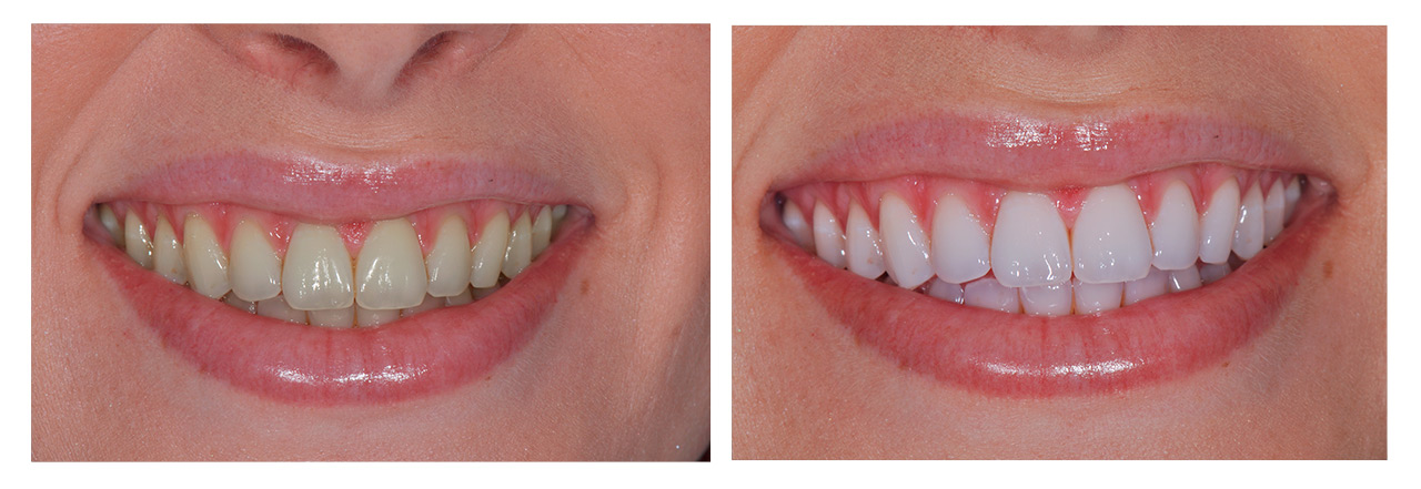 Zahnarztpraxis Dr. Nicola Schüren - Bleaching